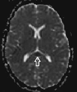 after 10 days. Second patient: A 22-year-old female patient presented with vomiting, nausea, and impaired vision. Neurological examination was normal.