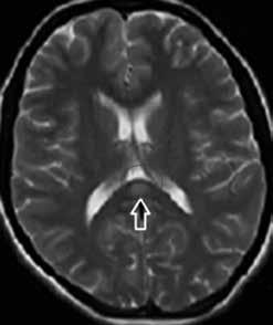 Diffusion weighed MRI showed a 9x11 mm focal, hyper-intense lesion with well-defined margins in SCC.
