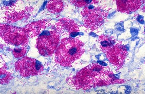 Mycobacterium avium, Mycobacterium intracellulare atipik