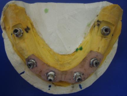 Freze makinesinde uygun uçlar değiģtirerek implantları parelel hale getiriniz.