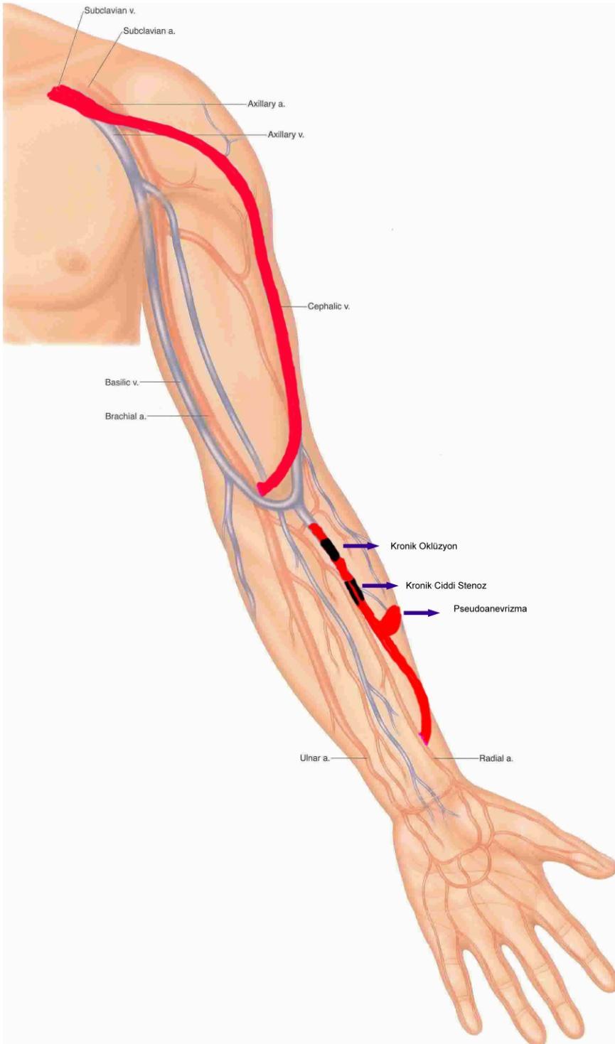 Dirsekte Brakio-Sefalik fistüle Dönüştürme Ön kolda fistülüze sefalik vende Anevrizma,