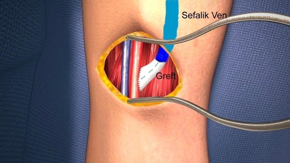 Brakio-Sefalik Fistülün Greft ile Revizyonu Brakio-Sefalik Fistülde Anastomozun ilk 1-3 cm lik segmentinde