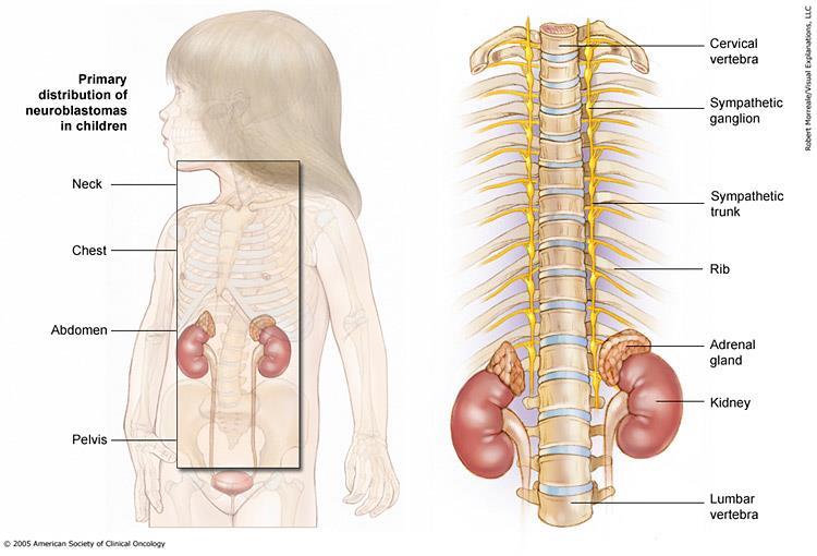 Periferal nöroblastik tümörler Periferal nöroblastik tümörler; nöral krestten köken, nöroblastom (NB), ganglionöroblastom intermikst(gnb), ganglionöroblastom nodüler ve ganglionörom (GN) olarak 4
