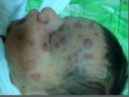 bebekleri Serebeller ataksi ya da opsoklonus/miyoklonus, paraneoplastik nörolojik bulgulardır.