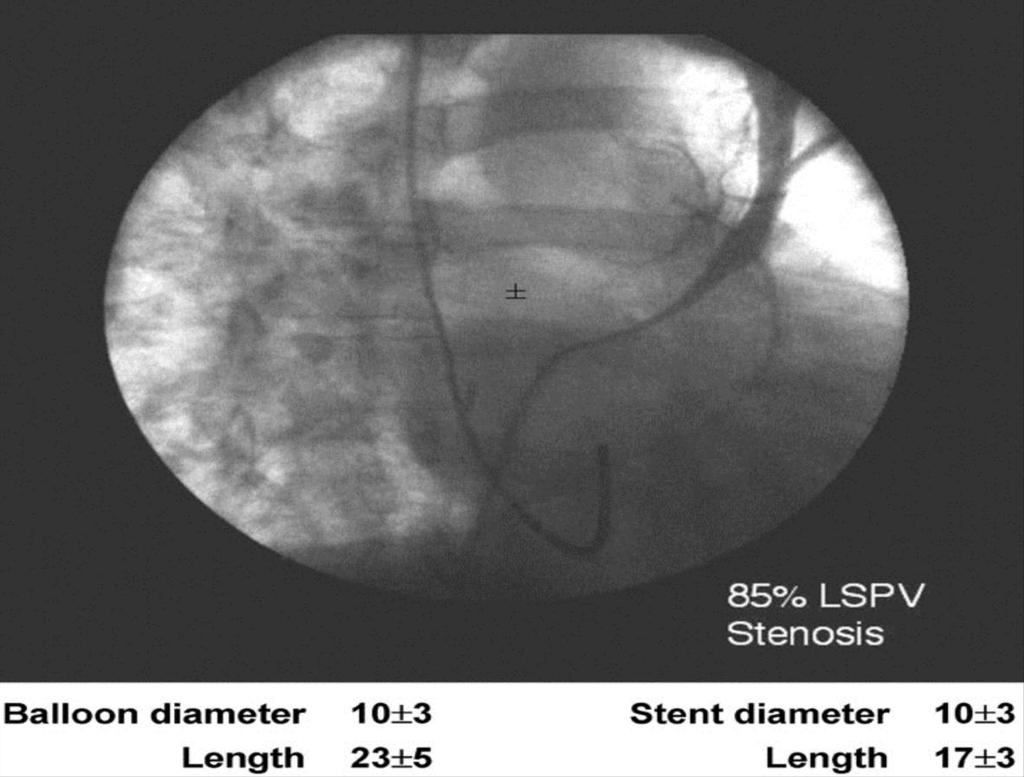 From: Pulmonary Vein Stenosis Complicating Ablation for Atrial Fibrillation: Clinical Spectrum and Interventional Considerations J Am Coll Cardiol Intv. 2009;2(4):267-276. doi:10.1016/j.jcin.2008.12.