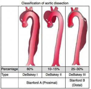 1.11 Aort diseksiyonunda sınıflamalar (Kaynak: http://www.acilci.