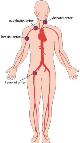 5 Resim 5. Arteriyel basınç noktaları 1.4.4 Atelleme Kanama, kırılan kemiğin sivri uçlarının kas ve damarları yırtması ile oluşmuşsa; kırılan kemiğin atellenmesi kanamayı durdurabilir veya yavaşlatır.