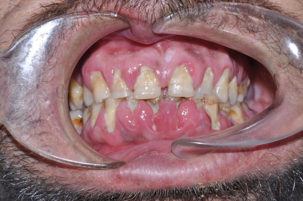 oluşan hastalıktır. Bu hastalıkta, dişin kökünü çene kemiğine bağlayan lifler zarar gördüğü için dişeti ile diş arasında cep adı verilen boşluk oluşur.