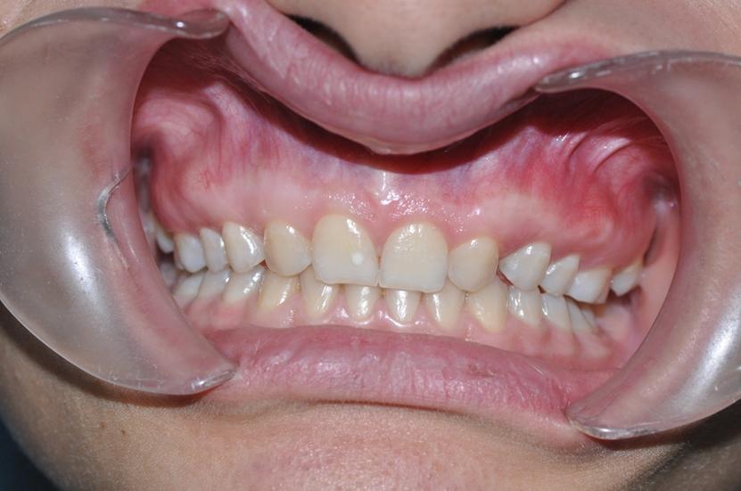 Ancak tüm periodontal hastalıklar ve defekler cerrahi işlemlerle tedavi edilemez.