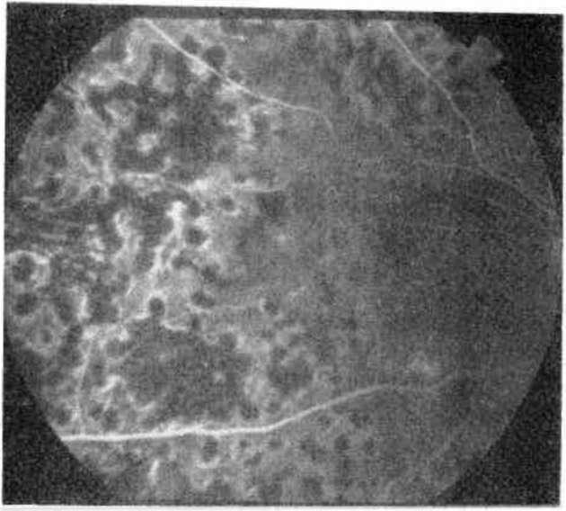 OFTALMOLOJİ MART 1993 CİLT 2 SAYI 1 Şekil 13a. Geniş hipoksik alan, retina neovaskülarizasyonu ve hafif vitreus kanaması. Şekil 13b.