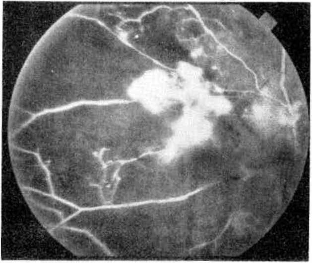 Non-perfüze alanların tam kapatılamadığı olgularda koagülasyon nedbelerinin arasında retina neovaskülarizasyonları gelişebilir (Şekil 14a-b, 15a-b).