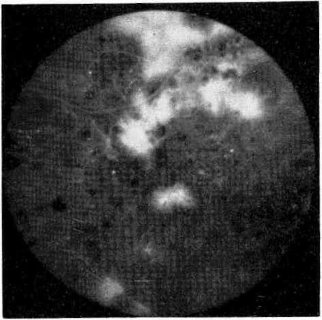 Tek Şekil 14a. Yetersiz yapılmış ışık koagülasyonu sonrası gelişen retina neovaskülarizasyonu. Şekil 14b. Aynı olguda nonpertüze alanlar ve retina neovaskülarizasyonunun tam olarak kapatılması.