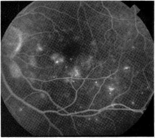 Hemoglobin tarafından emilen ancak maküladakl ksantofil pigmenti tarafından emilmeyen yeşil argon ve sarı dye laser tercih edilmelidir (7).