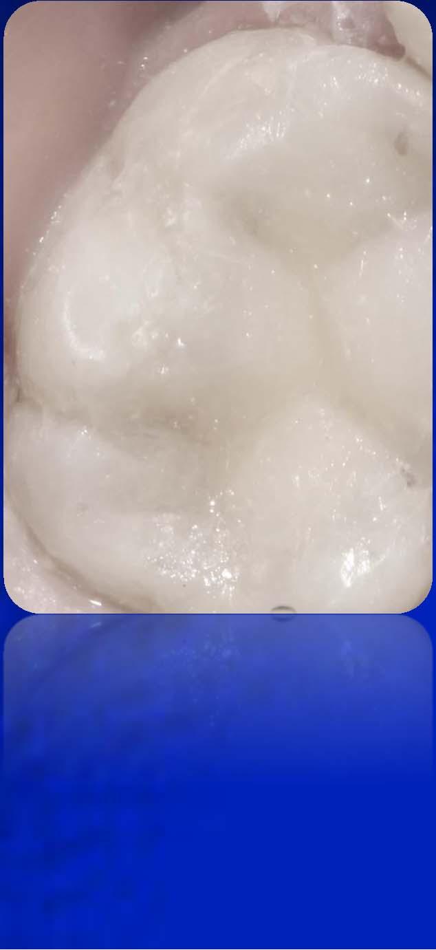 Feldspat (kalsiyum silikat sodyum) şeffaf (transparan) bir madde
