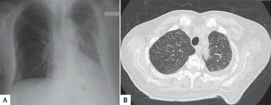 A: Olgu 1 e ait tedavi öncesi PA akciğer grafisinde, solda geçirilmiş travmaya sekonder kemik yapılarda değişiklikler ve akciğer hacminde küçülme, sağda alt