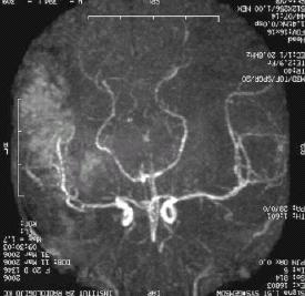 Neonatal Antifosfolipit Sendromu Maternal antifosfolipit antikorlarının geçişine bağlı gelişir Az sayıda vaka tanımlanmış Trombositopeni,