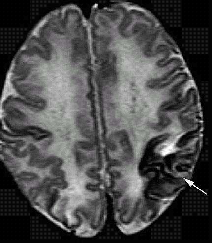 Serebral Ven Trombozu Konvulsiyon, letarji, apne, beslenme güçlüğü 2/3 yüzeyel, 1/3 derin venlerde Perinatal hipoksi sebep X sonuç 131 hipotermi uygulanan vakanın %2 sinde tromboz TOBY trial 2009