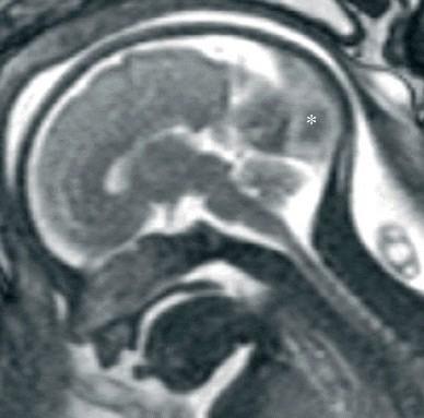 Yenidoğanda Serebral Ven Trombozu (n:42) Gebelik Preeklampsi, hipertansiyon % 26, Diabet %26, MAS % 24, Preterm eylem, fetal distress % 24 Klinik Konvülsiyon % 57, Apne %19,