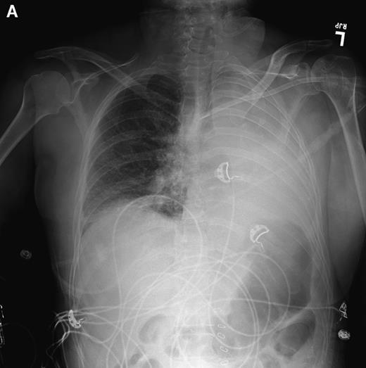 Atelektazi: Akciğer dokusunda hacim kaybı Tüm akciğeri, akciğerin bir lobunu ya da lobun bir parçasını