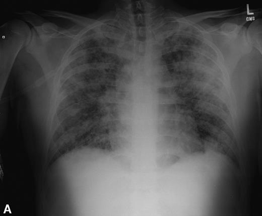 Her iki akciğerde bilateral yamalı opasiteler. Akut pulmoner ödem?