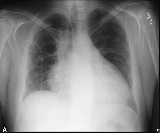 EKG: elektriki alternans