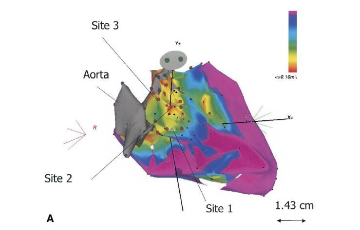 Endocardial and Epicardial Radiofrequency Ablation of Ventricular Tachycardia Associated With Dilated Cardiomyopathy İnfarkt sonrası ventrikül taşikardisinin mekanizması iyi bilinmektedir, ancak