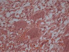 Yapılan tetkik sonucu; hazırlanan kesitlerde prolifere fibroblastların oluşturduğu bir zeminde küçük kapiller yapılar ve çok sayıda multinükleer dev hücreler ile karakterize lezyon izlenmiştir.