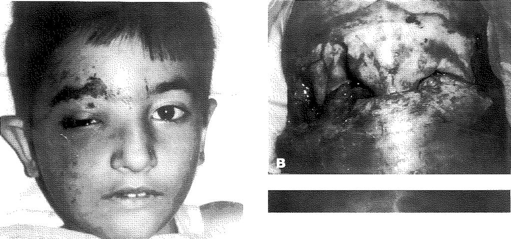 A: Preoperatif görünüm B: întraoperatif