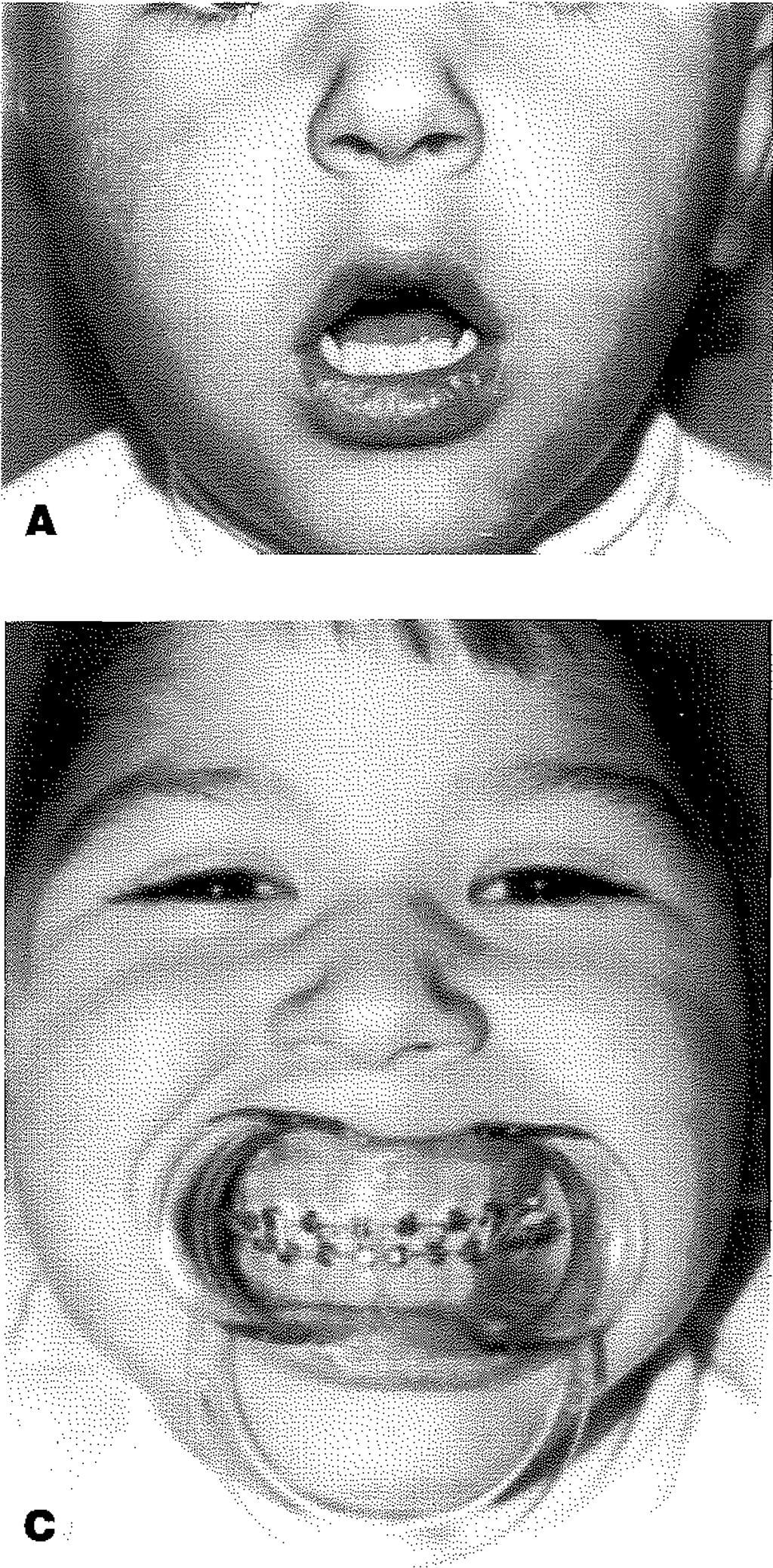 oklüzyonun görünümü. diş tomurcuklarıdır. Çocuklarda kırık hatlarmdaki diş çıkartılmamalı ve daha konservatif kalınarak bu tür kırıklara minimal girişim önerilmektedir.