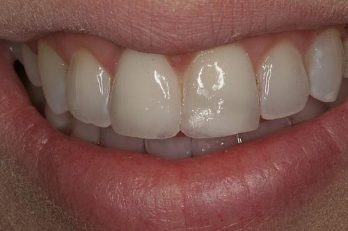 Çoğu zaman dişler sorun çıkmaksızın basit dental girişimler ile