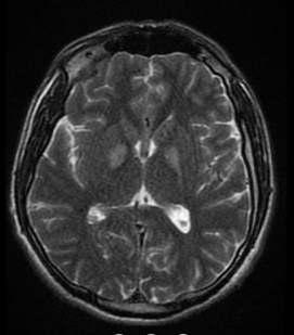 Sentetik kannabinoid kullanýmý olan hastada bilateral globus pallidus lezyonu ile iliþkili frontal lob sendromu ve bellek kaybý yonu meydana gelen ve hareket bozukluðu olmadan frontal lob sendromu