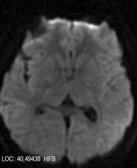 Sentetik kannabinoid kullanýmý olan hastada bilateral globus pallidus lezyonu ile iliþkili frontal lob sendromu ve bellek kaybý Resim 3: Difüzyon aðýrlýklý görüntülerde kýsýtlý difüzyon alaný