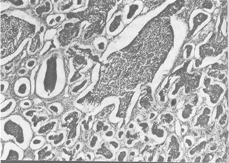 Ýnfiltratif bazal hücreli karsinom:deðiþik boyutlarda düzensiz daðýlým gösteren çit yapýsý iyi geliþmemiþ tümör adacýklarý izlenmektedir. keratotik, kistik ve adenoid türlerdir (5).