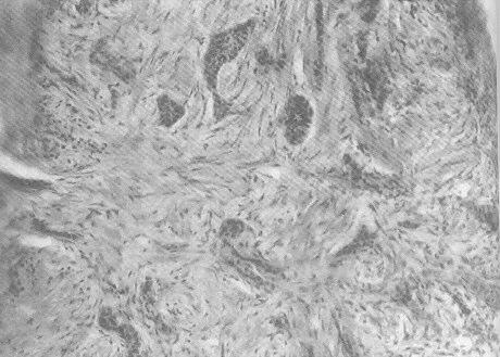 Cerrahi sýnýrlarda tümör hücresi varlýðý %6 civarýndadýr (1,6,7).