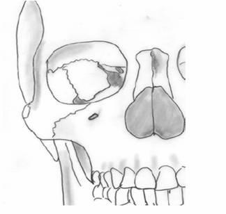 1 1. GİRİŞ Foramen infraorbitale, göz çukurunun alt kenarını sınırlayan margo infraorbitalis in orta noktasından yaklaşık olarak 8 mm kadar altta yer alır.