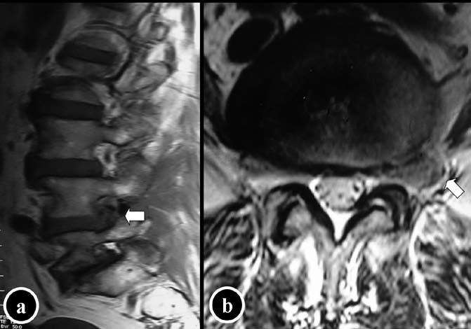 GİRİŞ Tüm lumbar disk hernilerinin %0,7 11,7 sini oluşturan uzak lateral disk henileri faset eklemin altında veya lateralinde bulunmaktadırlar (2,14,20).