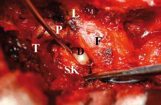 Pars arteri görülüp koagule edildikten sonra transvers process ve pars ın altyüzü dissektör ile etraf dokulardan ayrılarak intertransvers ligaman ortaya konulmuştur.