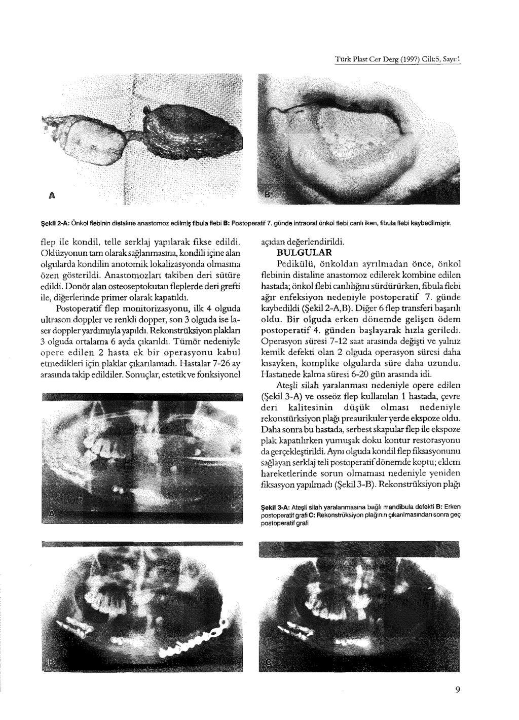 Türk Plast Cer Derg (1997) Cilt: 5, Sayı:l Şekil 2-A: Önkol fiebinin distaline anastomoz edilmiş fibula flebi B: Postoperatif 7. günde intraoral önkol flebi canlı iken, fibulaflebi kaybedilmiştir.