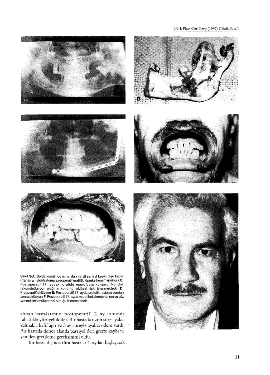 Türk Plast Cer Derg (1997) CiltS, Sayı:l Şekil 5-A: Solda kondili de içine alan