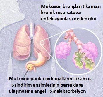 yolu enfeksiyonu yakınması olan hastalarda