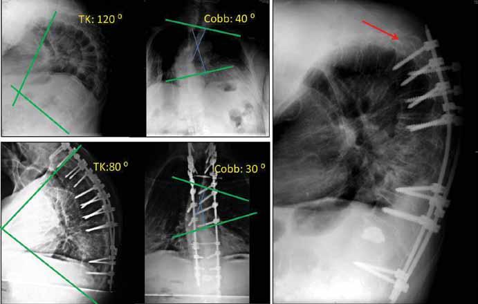 A b c Şekil 6: a) Torakal erişkin deformitesi (skolyoz+kifoz) olan 63 yaşındaki erkek hasta, nefes almada güçlük, başının öne eğilmesi ve yürümede güçlük yakınmaları ile başvurdu.