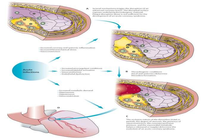İleri bir koroner lezyonun parçalanmasını tetkileyen pek çok faktör mevcuiur. Bozulmuş yüzey aliaki trombojenik materyali ortaya çıkarmaktadır.