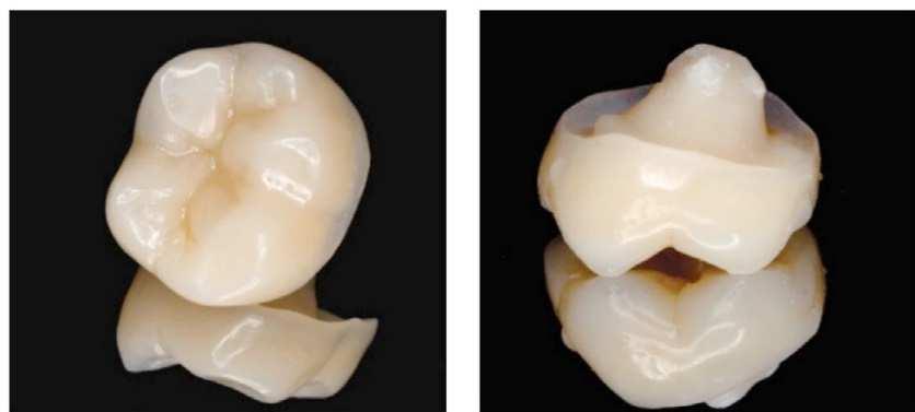 10 Şekil 2.2. Endokron restorasyon (Dzieciatkowska, 2015)