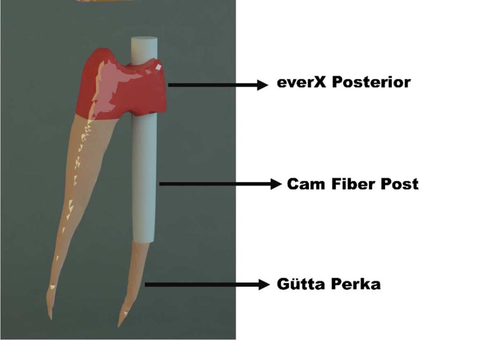 46 Post ile Direkt Restorasyon Cam fiberle güçlendirilmiş paralel post materyali, palatinal kanala apikalinde 5 mm gütta perka kalacak şekilde yerleştirilmiştir.