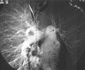 A B Resim 1. Sol pulmoner arter hipoplazisi bulunan olgunun A.