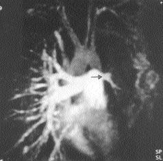MRA da pulmoner arteriyel fazda al nan görüntüde pulmoner vasküler yap lar ve hipoplazik arterin (ok) görünümü. emens Medical System) yap ld.