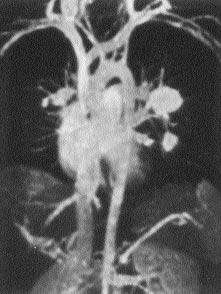 MRA ile pulmoner arteriyel fazda al - nan görüntülerde sağ ana pulmoner arterde hipoplazi ve sistemik venöz fazda al nan görüntülerde sağda diyafragman n hemen alt nda İVK'ya direne olan scimitar