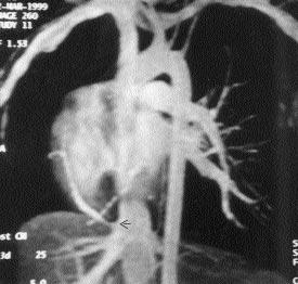 MRA'da sistemik arteriyel-venöz fazda anormal drenaj veninin diyafragman