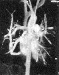Resim 5. Koronal düzlemde al nan 3B rekonstrüksiyon oluflturulmam fl MRA görüntüsünde sa pulmoner arterde emboli (ok). Resim 4.