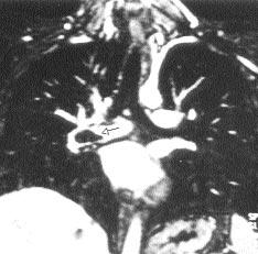 de hipoplazi, kalp ve mediastende sağa kayma, sağ hilustan başlayarak medial posteriordan diyafragmaya uzanan ve burada kavislenen vasküler yap izlendi (Resim 6A,B).